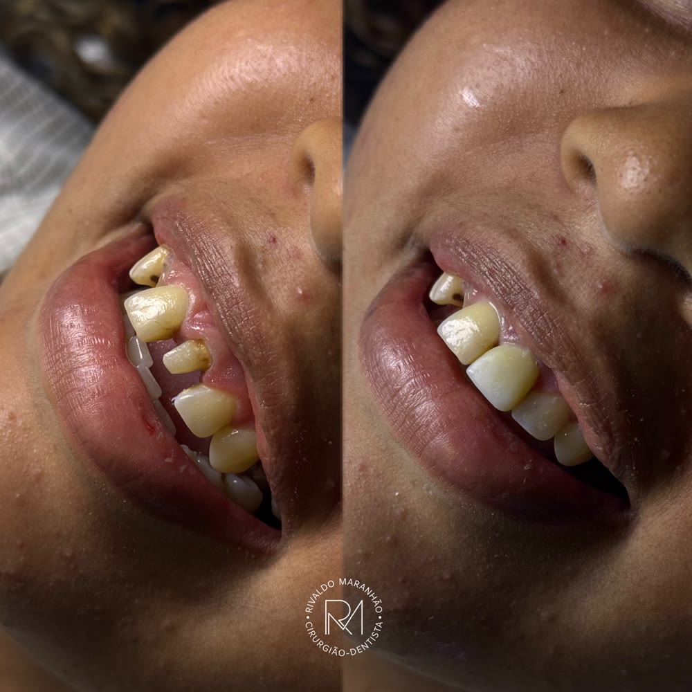 Antes e depois: facetas em resina