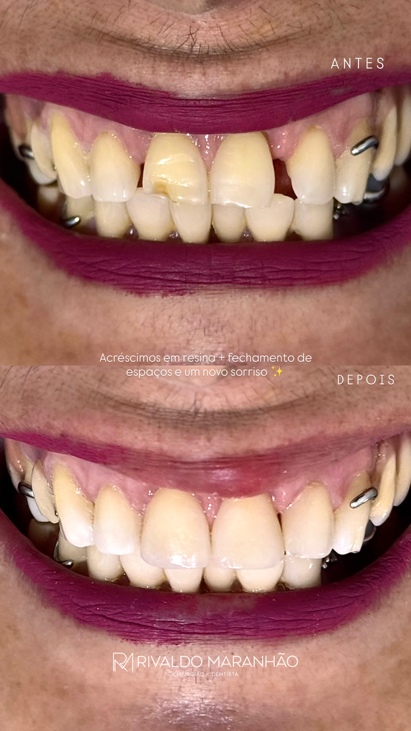 Antes e depois: acréscimos em resina e fechamento de espaços
