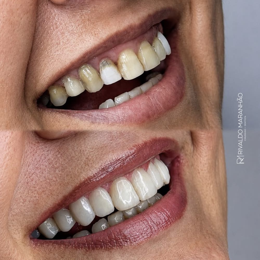 Antes e depois: facetas em resina