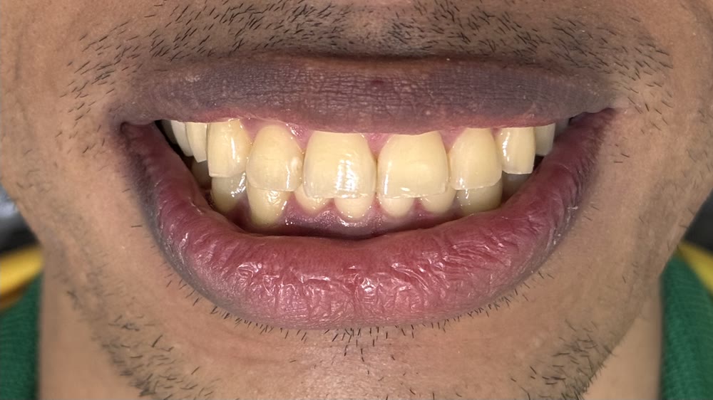 Dentes amarelados antes do clareamento