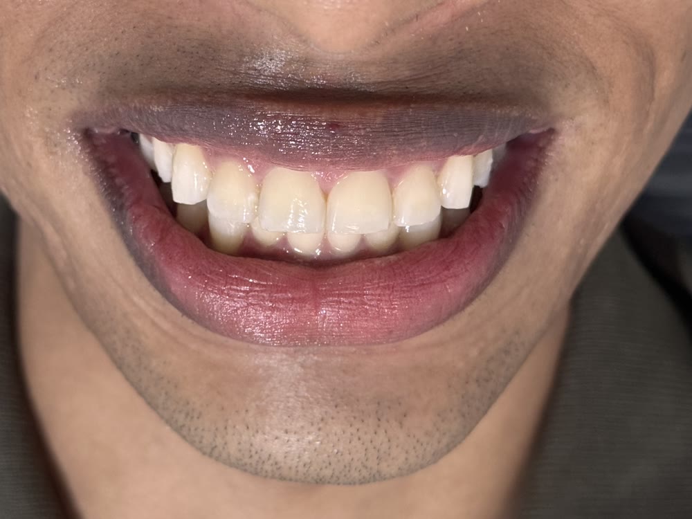 Dentes mais claros depois do clareamento