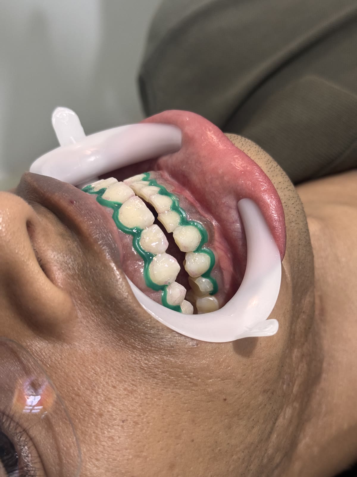 Clareamento em andamento com barreira de proteção da gengiva