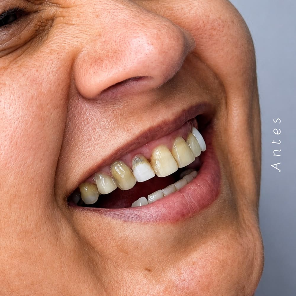 Sorriso antes das facetas em resina